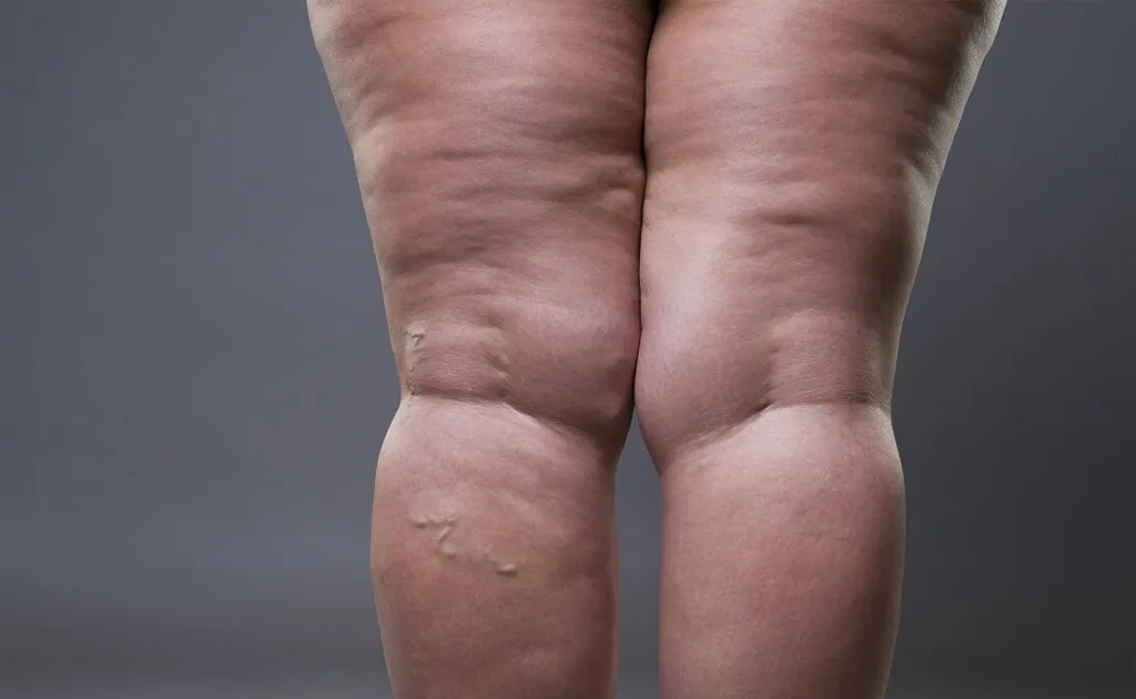 lipedema
